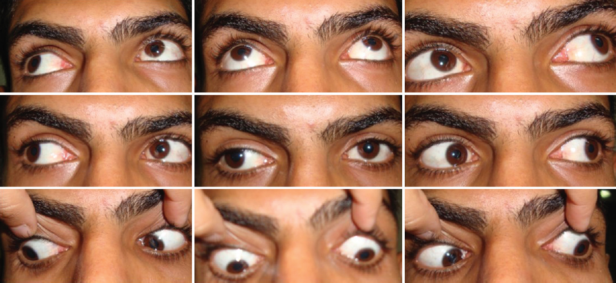Unpredictable and unwanted consequences of combination of alcohol with other drugs. A 24 yr old male with a visual acuity of 6/6 in both eyes with normal pupillary reactions but 45 prism dioptre of exotropia in the right eye with full extraocular movements in all gazes. Patient presented with binocular diplopia for 4-5 months following intake of marijuana and alcohol. On the basis of multiple infarcts on magnetic resonance imaging brain, a diagnosis of reversible cerebrovascular spasm syndrome was made.