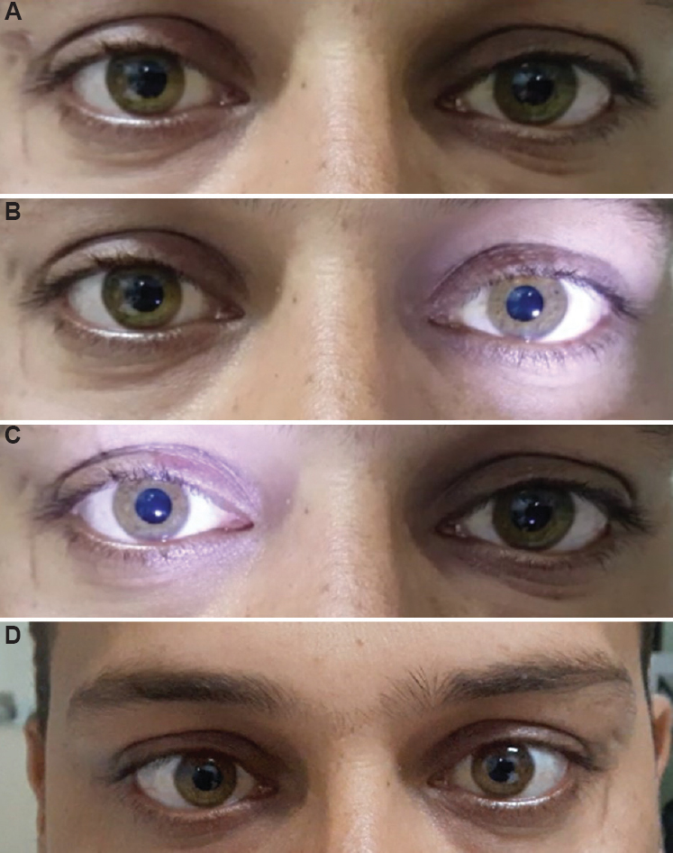 Dilated pupils in both eyes (A) and sluggishly reacting on direct and consensual reflexes (B and C) as well as near reflex (D) in a 25 yr old male patient with a history of smoking marijuana. Patient presented with a one week history. Pilocarpine one per cent drops were described to relieve symptoms.