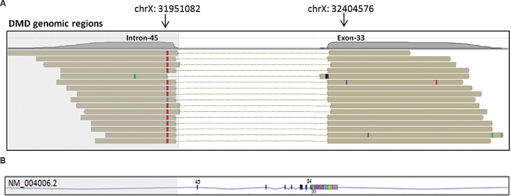 (A) Split-read alignment: In split-read alignment, input sequence reads split into two segments, mapping each segment to a different location on the reference genome as represented by the horizontal brown bars. Mismatch with respect to the reference genome in each sequence reads are shown as red, green and black bars. As seen in this Figure, each read aligns to exon 33 and intron 45 of the DMD gene. The deletion breakpoints are represented with arrows, (B) Lower panel shows the corresponding transcript region of the DMD transcript (NM_004006.2) in reverse strand, to which the split-reads map. Vertical bars represent exons. Based on this, it was accurately determined that the deletion encompassed 149 bp from the 3' end of exon 33 and complete deletion of exons 34-45 of the DMD gene. DMD, Duchenne muscular dystrophy.
