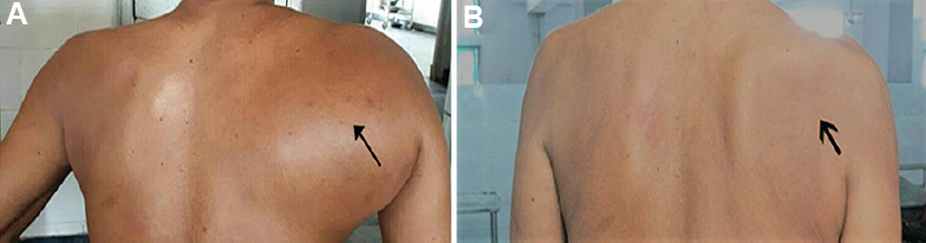 (A) Arrow shows swelling on the posterior aspect of the right shoulder. (B) Arrow shows reduction in the size of swelling after six cycles of chemotherapy and involved-field radiotherapy.