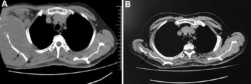 (A) Arrow in the axial section of the computed tomography image of the right shoulder shows a large soft-tissue mass with permeative destruction of the right scapula and enlarged axillary and pectoral lymph nodes. (B) Arrow in the axial section of the computed tomography image of the right shoulder shows regression of the soft-tissue mass with immunochemotherapy and radiotherapy.