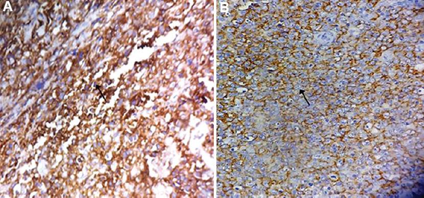 (A) Immunostaining of the tissue section shows positive membrane staining of CD45 in 85 per cent cells as shown in brown colour suggestive of non-Hodgkin's lymphoma as pointed by the arrow mark. (B) Immunostaining of the tissue section shows positive membrane staining of CD20 in 65 per cent cells as shown in brown colour suggestive of diffuse large B-cell lymphoma as pointed by the arrow mark.