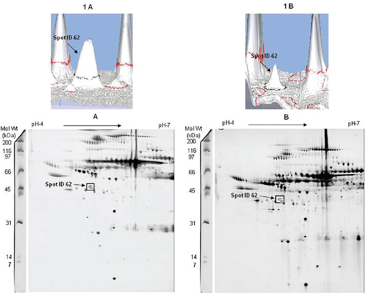 Two-dimensional gel electrophoresis image of a participant with deliberate self-harm and matched control. Representative gel image of plasma proteins of an age- and gender-matched healthy control (panel A) and a participant with deliberate self-harm (panel B) with differentially expressed protein spot (spot ID - 62). Inset (1A) and (1B) depicts the three-dimensional view of the intensity of spot 62 present in a control and a participant with deliberate self-harm, respectively.