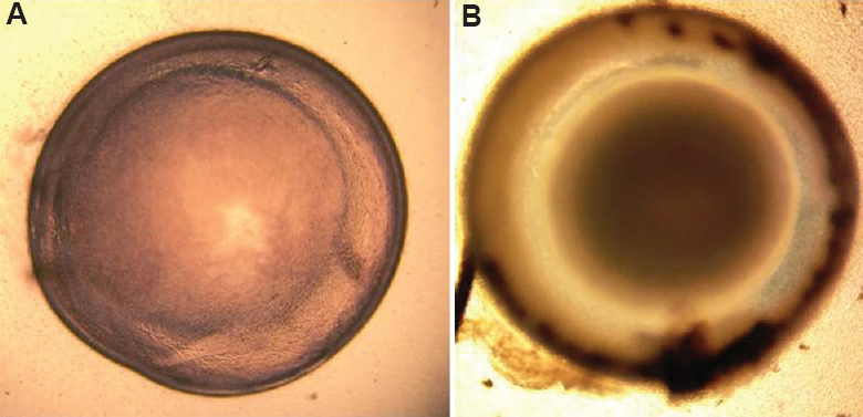 (A) Lens image with grade 1 cataract in the group treated with betaine, (B) lens image with grade 5 cataract in the group treated with hydrocortisone.