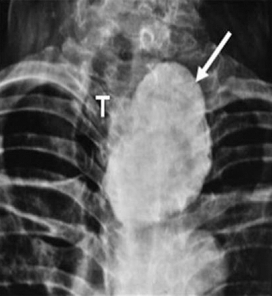 X-ray of the neck (anteroposterior view) showing a large calcified mass (arrow) displacing the trachea (T) towards the right side.