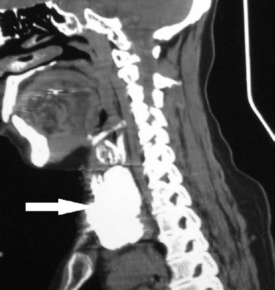 Computed tomography of the neck (sagittal view) showing the large calcified mass (arrow).