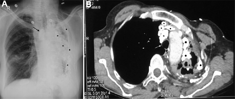 A 52 yr old female, presented with shortness of breath and cough with expectoration. Mycobacterium kansasii was repeatedly isolated from sputum. (A) Her chest skiagram (posteroanterior projection) shows sequelae of pleuro-pulmonary tuberculosis in the form of mediastinal shift to the left, lymph nodal (arrow) and extensive pleuroparenchymal calcifications (asterisks) along with marked volume loss (atelectasis) of the left lung. The right lung shows compensatory hyperinflation. (B) Computed tomography (CT) chest of the same patient showing tracheal shift to the left (white arrow pointing to tracheal bifurcation and black arrow head to displaced carina) and multiple calcifications in lymph nodes (asterisks). Filled black circles show pleuroparenchymal calcifications. Hyperinflation of the right lung is also seen.