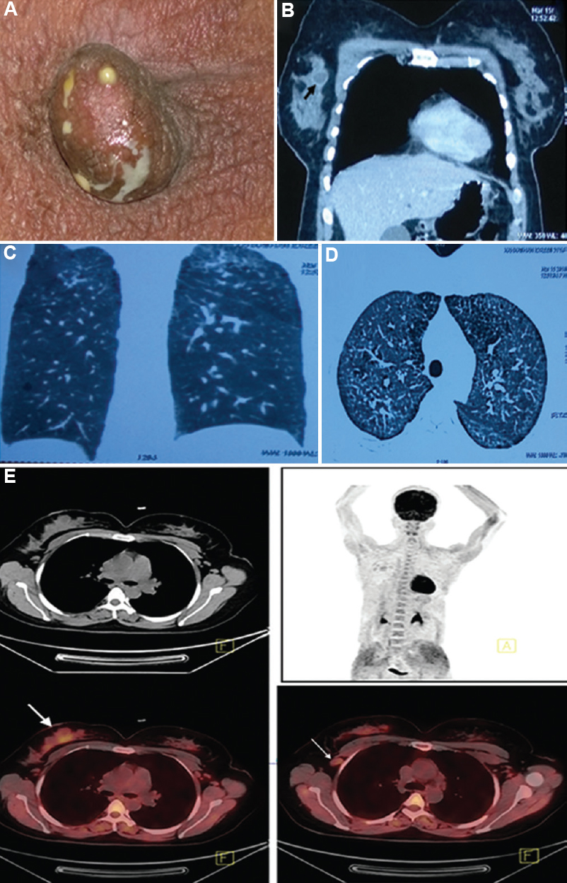 (A) A 35 yr old female presented with discharge from the right nipple, Mycobacterium abscessus was isolated from the pus on several occasions prior to treatment. (B) CT chest showing enhancement of the margin of the abscess (black arrow) with intravenous contrast. (C and D) Coronal and axial sections of the CT of the chest show changes of chronic hypersensitivity pneumonitis due to exposure to domestic pigeons. (E) FDG PET-CT images of the same patient with discharge from the right nipple, showing FDG-avid right breast lesion (thick arrow) and right axillary lymphadenopathy (thin arrow). FDG, 18F labelled 2-deoxy-D-glucose; PET, positron emission tomography.