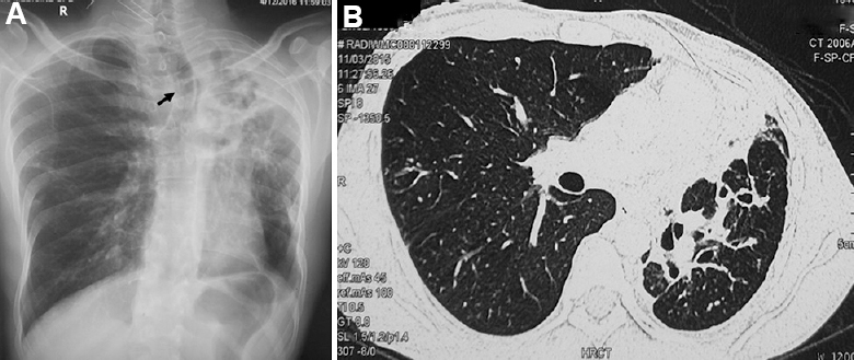 (A) Chest skiagram of a 30 yr old male showing atelectasis of the lung with marked mediastinal shift (black arrow points to the tracheal shift). (B) Axial section of CT chest of the same patient showing atelectasis of the left upper lobe with architectural distortion of airways resulting in bronchiectasis.