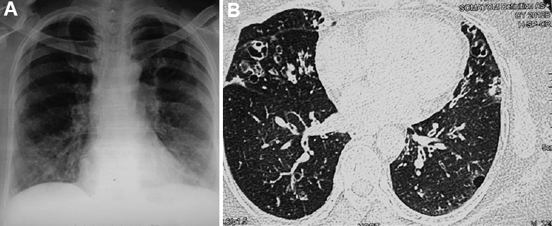 (A). Chest radiograph of a 63 yr old female showing bilateral bronchiectasis in a patient with asthma and allergic bronchopulmonary aspergillosis. (B) Axial section on high resolution CT chest showing bilateral bronchiectasis in the right middle lobe, lingula and lower lobes. Mycobacterium simiae was repeatedly isolated from the sputum.
