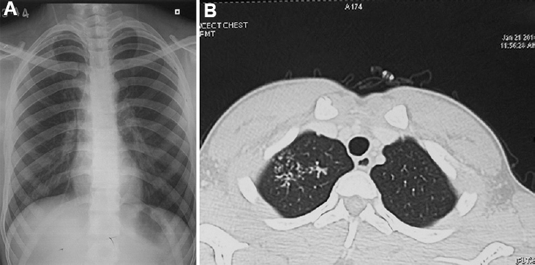 A 18 yr old male presented with cough and expectoration, sputum examination revealed Mycobacterium intracellulare. (A) Chest radiograph showing infiltration in the right upper lobe. (B) Axial section of CT chest showing tree-in-bud appearance in the right upper lobe.