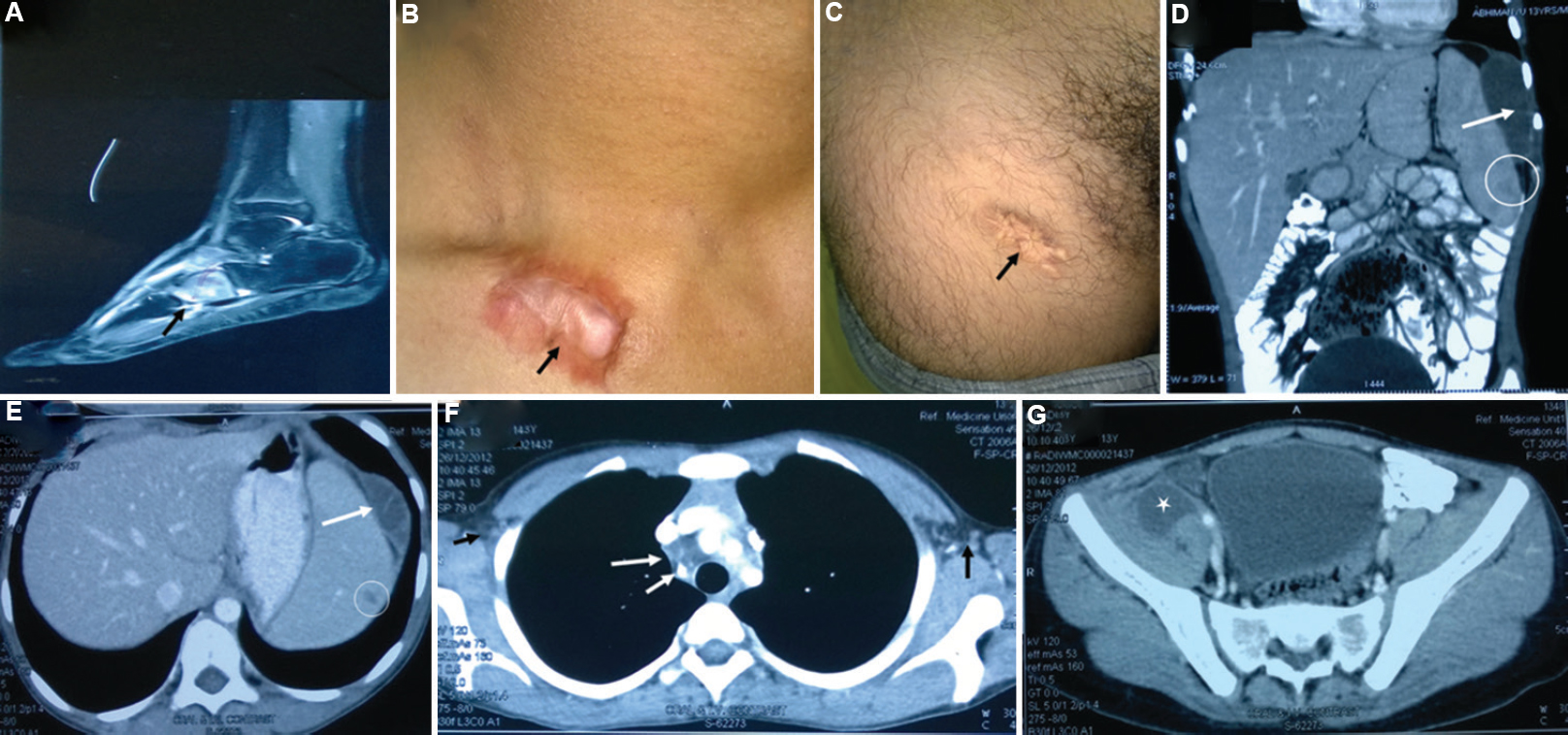 The patient had disseminated Mycobacterium intracellulare infection; no immune defect could be detected. He was successfully treated. (A) The MRI scan picture shows osteomyelitis of foot bone (black arrow). (B) Black arrow shows healing of cutaneous lesion by keloid formation. (C) Upper part of thigh shows another healed skin lesion (black arrow). (D and E) Hypodense lesions in the spleen (white open circles) and peri-splenic abscess (white arrows). (F) Bilateral conglomerate necrotic axillary (extreme-left and -right arrows) and right paratracheal lymph nodes (long and short arrows in the centre of CT image), calcification is also noted in the lymph nodes. (G) Iliopsoas abscess on the right side (white asterisk).