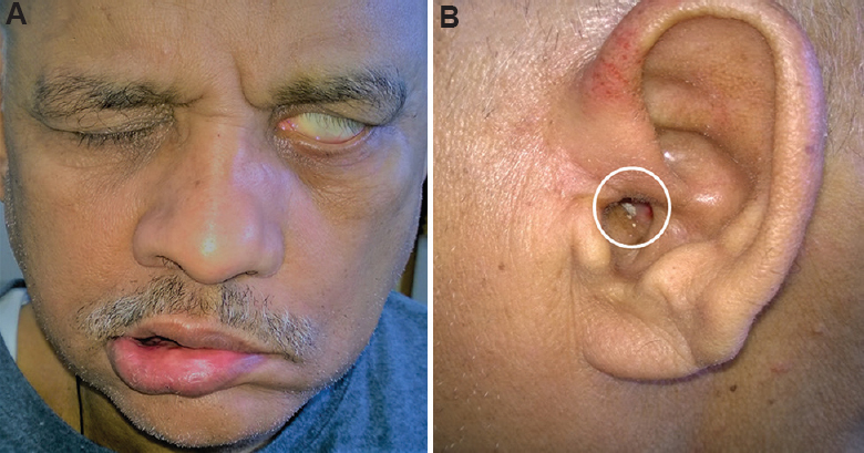 (A) Clinical picture of a 58 yr old patient with Mycobacterium parascrofulaceum disease. The patient had lower motor neurone type of left facial nerve palsy. The disease produced left orbital cellulitis resulting in left-sided blindness, mastoiditis, involvement of apex of the petrous bone and meningitis. (B) Pus discharge (white open circle) from the left ear is visible which disappeared on follow up.