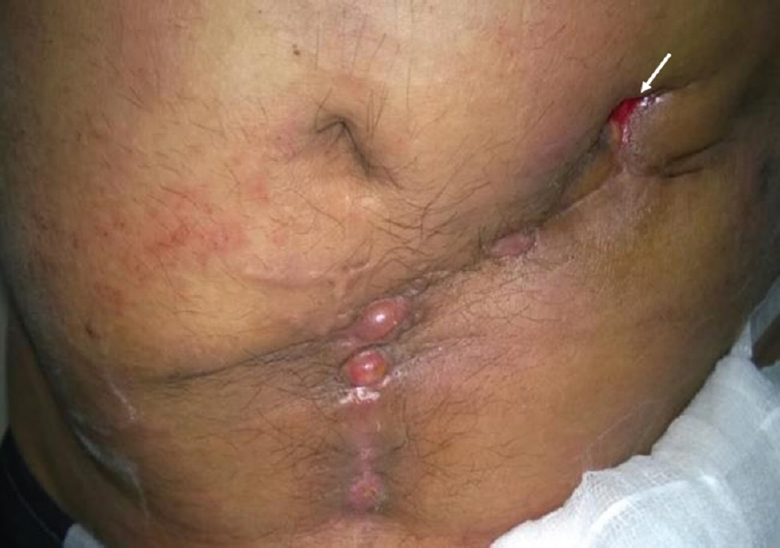 Clinical photograph of a 35 yr old male, showing discharging sinus (white arrow) in the abdominal wall in a patient infected with Mycobacterium abscessus following left inguinal hernia repair with mesh.