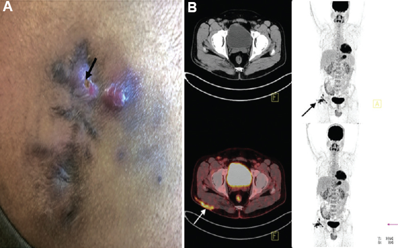 (A) Clinical photograph of a 30 yr old male, showing right-sided post-injection gluteal abscess (black arrow) in a patient with NTM infection. (B) Transaxial fused FDG PET-CT image of the same patient, at the level of acetabulum showing FDG accumulation in the subcutaneous thickening and stranding (arrow) involving the underlying right gluteus muscle superficially in right gluteal region.
