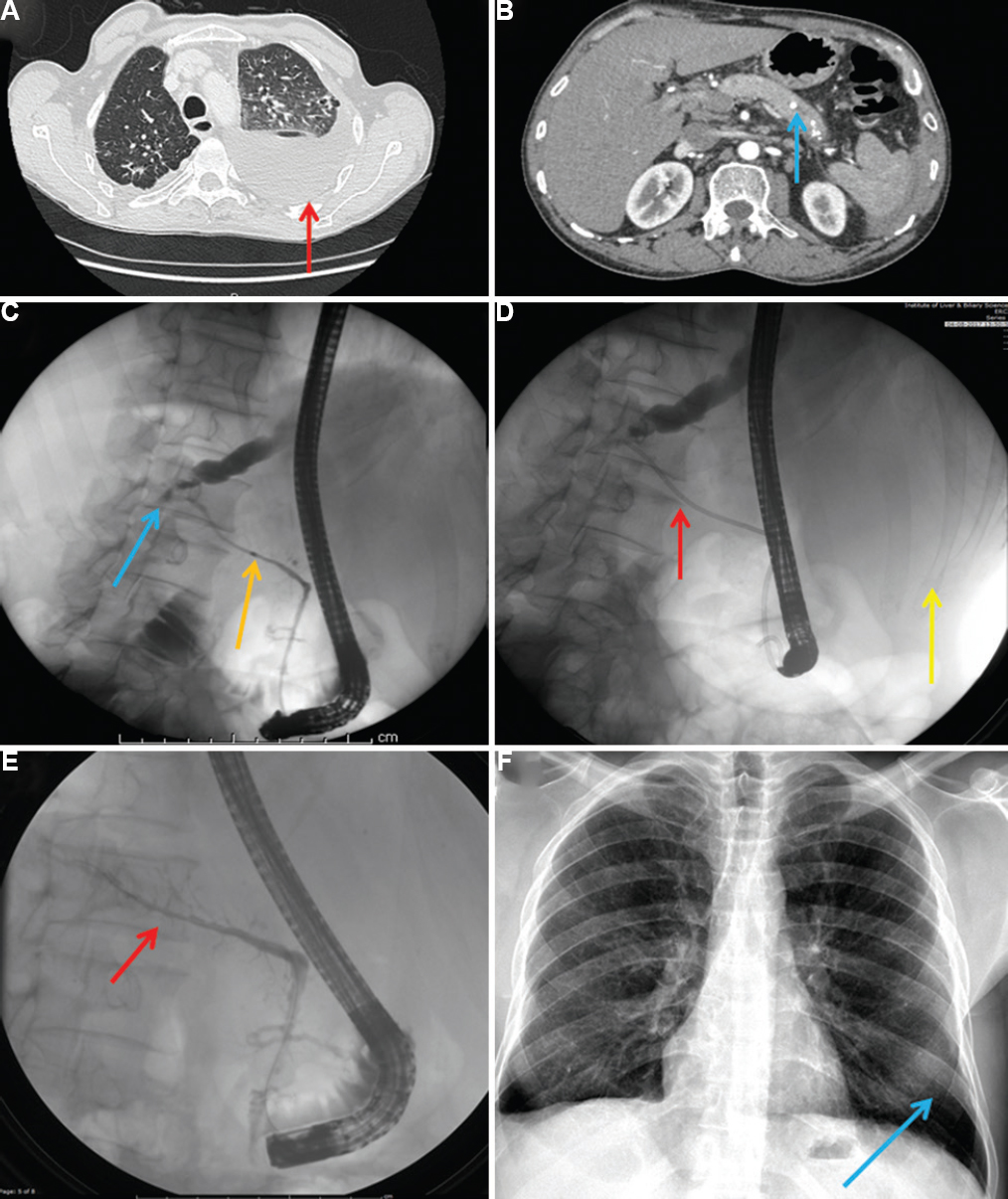 (A and B) Computed tomographic image of chest and abdomen showing left-sided pleural effusion (red arrow in panel A) and features of chronic calcific pancreatitis (blue arrow in panel B), (C) Endoscopic retrograde pancreatogram showing leak of contrast from the main pancreatic duct (yellow arrow showing the pancreatic duct and blue arrow showing the leak), (D) Endoscopic retrograde pancreatogram showing a stent placed in the pancreatic duct (red arrow), with the patient lying in left lateral position (yellow arrow shows the ribs with the underlying lung parenchyma), (E) Endoscopic retrograde pancreatogram showing absence of leak from the main pancreatic duct (red arrow), (F) Chest X-ray showing clearance of the pleural effusion (blue arrow).
