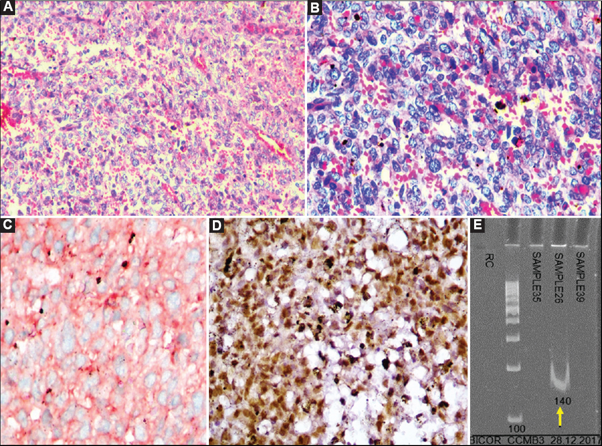Case 20: Undifferentiated sarcoma showing positive BCOR-CCNB3 fusion. (A) Malignant tumour composed of round to spindly cells in a richly vascularized stroma (H and E, ×200), (B) Higher magnification showing round to oval cells with vesicular to hyperchromatic nuclei, indistinct nucleoli and scant cytoplasm in a vascularized stroma (H and E, ×400), (C) Tumour cells showing diffuse cytoplasmic to ‘dot-like', focally membranous staining for MIC2/CD99 (DAB, ×400), (D) CCNB3 positivity (DAB, ×400), and (E) Polymerase chain reaction result showing positive band for BCOR-CCNB3 fusion transcript (140 bp) (arrow).