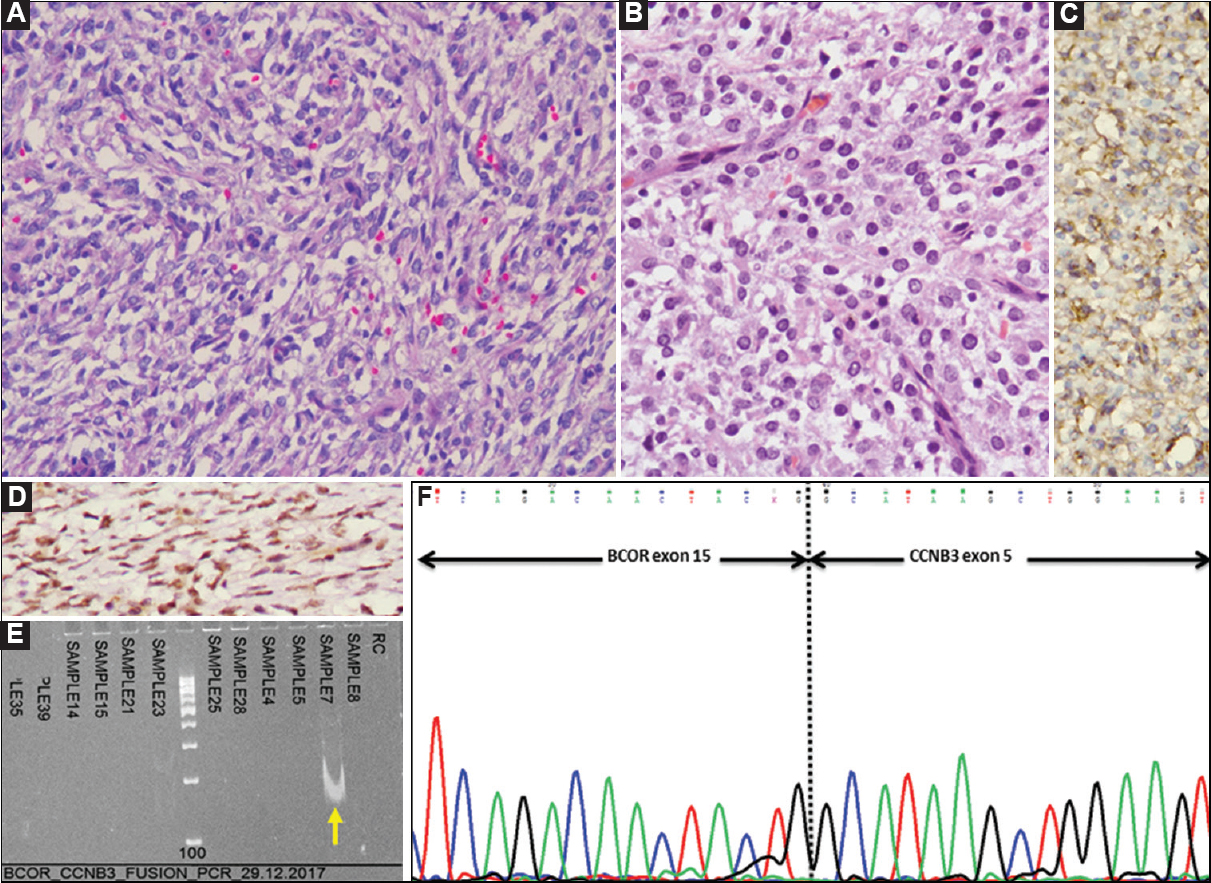 Case 24: BCOR-CCNB3-positive undifferentiated round cell sarcoma. (A) Microscopically, a tumour comprising round to spindle shaped cells, including a few angulate forms in a vascularized stroma (H and E, ×200), (B) Tumour cells with round nuclei and scant to moderate, eosinophilic cytoplasm (H and E, ×400), (C) By immunohistochemistry (IHC), tumour cells showing cytoplasmic and ‘dot-like’ MIC2/CD99 positivity (DAB, ×400). (D) CCNB3 positivity (DAB, ×400), (E) Polymerase chain reaction result showing positive band for BCOR-CCNB3 fusion transcript (140 bp) (arrow), and (F) Sanger sequencing result showing BCOR-CCNB3 fusion.