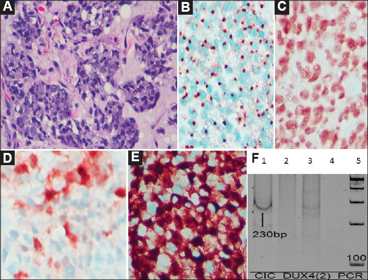 Case 37: Undifferentiated round cell sarcoma, (A) Round to polygonal cells arranged in a nesting pattern (H and E, ×400), (B) By IHC, tumour cells display ‘dot-like’ positivity for MIC2/CD99 (DAB, ×400), (C) INI1/SMARCB1 is diffusely retained in the tumour cells (DAB, ×400), (D) Focal distinct patchy positivity for calretinin (DAB, ×400), (E) Strong intranuclear and paranuclear positivity for WT1 (DAB ×400), and (F) Polymerase chain reaction result showing positive band for CIC-DUX4 fusion transcript (230 bp) (arrow).