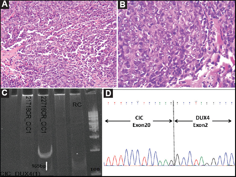 Case 44: Undifferentiated round cell sarcoma. (A) Nodular tumour composed of round to polygonal cells arranged in a diffuse pattern (H and E, ×200), (B) Higher magnification showing presence of polygonal cells with scant to moderate cytoplasm and discernable nucleoli (H and E, ×400), (C) Polymerase chain reaction result showing positive band for CIC-DUX4 type I fusion transcript (165 bp) (arrow), and (D) Sanger sequencing result showing CIC-DUX4 fusion, on electropherogram.