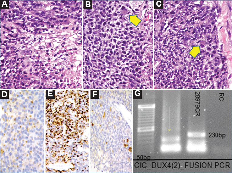 Case 45: Undifferentiated round cell sarcoma. (A) Malignant tumour comprising round to polygonal cells with central necrosis (H and E, ×200), (B) Higher magnification showing predominant round to oval cells with interspersed large cell containing abundant eosinophilic cytoplasm, reminiscent of ‘rhabdoid-like’ cell (arrow head) (H and E, ×400), (C) Epithelioid to ‘rhabdoid-like’ cells (H and E, ×400), (arrow head), (D) ‘Dot-like’ positivity for AE1/AE3 (AB, ×400), (E) WT1 positivity (DAB, ×400), (F) Focal calretinin positivity (DAB, ×400), and (G) Polymerase chain reaction result showing positive band for CIC-DUX4 type II fusion transcript (165 bp) (arrow).