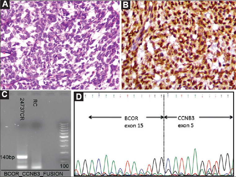 Case 46: (A) Sarcoma comprising round to oval and spindly cells arranged in a diffuse manner with intervening thin-walled blood vessels (H and E, ×200) (B). Intranuclear and paranuclear positivity for CCNB3 (DAB, ×400). (C) Polymerase chain reaction result showing positive band for BCOR-CCNB3 fusion transcript (140 bp), and (D) Sanger sequencing result showing BCOR-CCNB3 fusion, on electropherogram.
