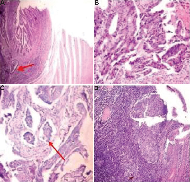 Adenocarcinoma with (A) regular borders (red arrow depicting the border) (B), with irregular borders (C), with lymphovascular emboli (red arrow depicting emboli) (H and E, ×100), and (D) dense inflammation around tumour making identification of tumour buds difficult (H and E, ×200).