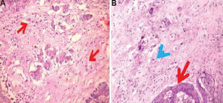 Intratumoural buds (A) (H and E, ×200) (red arrows depict the abnormal cells), and (B) peritumoural buds (H and E, ×400) (red arrow depicts tumour and blue arrow shows peritumoural buds).