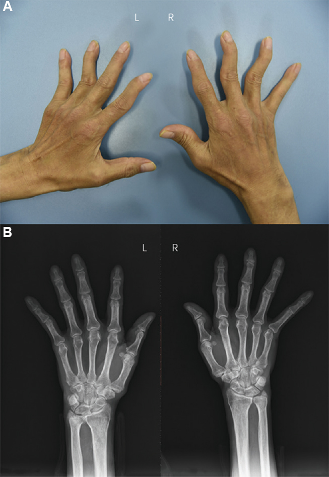 (A) Clinical picture showing swan-neck deformity on both the hands. (B) Radiograph of the hands showing no bone erosions. L, left; R, right.