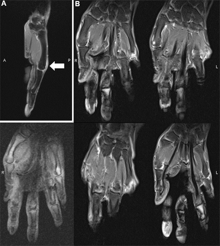(A) Sagittal magnetic resonance imaging of hands showing enthesitis (arrow), and (B) coronal magnetic resonance imaging revealing no bone marrow oedema nor cortical damage.