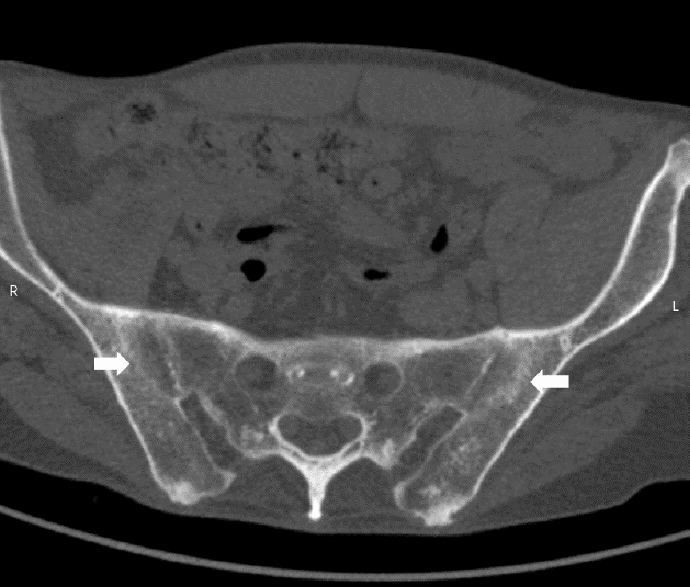 Computed tomography scan of the pelvis revealing bilateral sacroiliitis grade III (arrows).