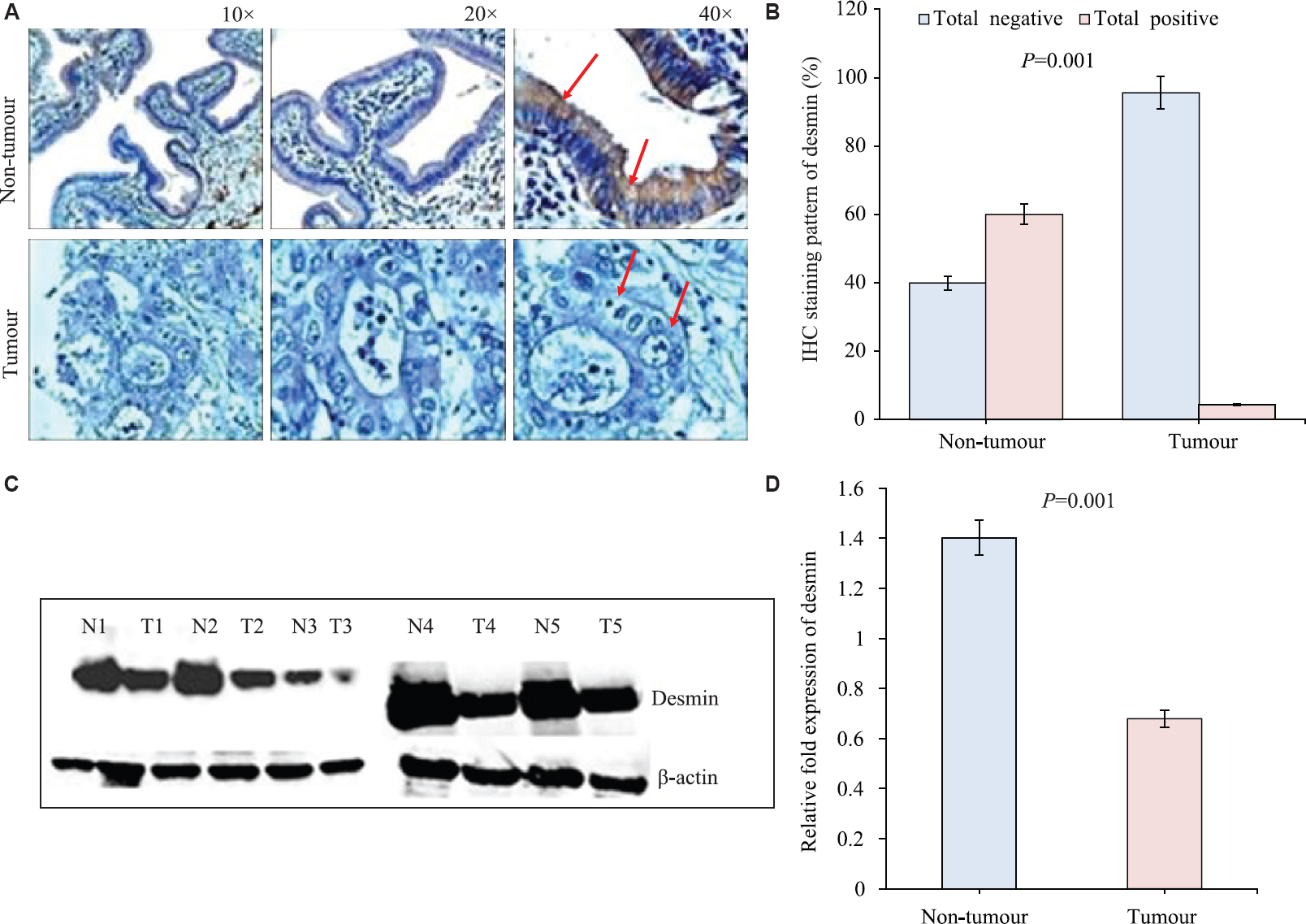 (A) Representative images of immunohistochemistry staining of desmin in gall bladder tumours (no diaminobenzidine, DAB stain) and adjacent non-tumour showing positive DAB stain, counterstain used was haematoxylin. (B) Histogram showing percentage of immunohistochemical staining patterns of desmin in gall bladder tumours and adjacent non-tumours. (C) Western blotting showing expression of desmin in five representative samples of gall bladder tumour (T1-T5) and their adjacent non-tumour (N1-N5). (D) Histogram showing the densitometric quantitation of desmin expression in gall bladder tumours and non-tumours from the western blotting (n=5 in both groups).
