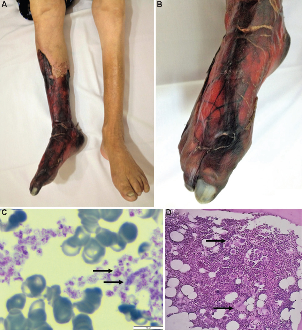 (A and B) Appearance of the patient's right leg and ankle. (C) Thrombocytosis in the patient's peripheral smear with staining (May-Grunwald and Giemsa, ×1000; scale bar 10 μm). The differences in platelet size are remarkable (arrows). (D) Marrow trephine biopsy (Hematoxylin & Eosin X, ×20) showing megakaryocyte proliferation with hyperlobulated forms in the marrow specimen of the patient (arrows pointing to megakaryocytes).