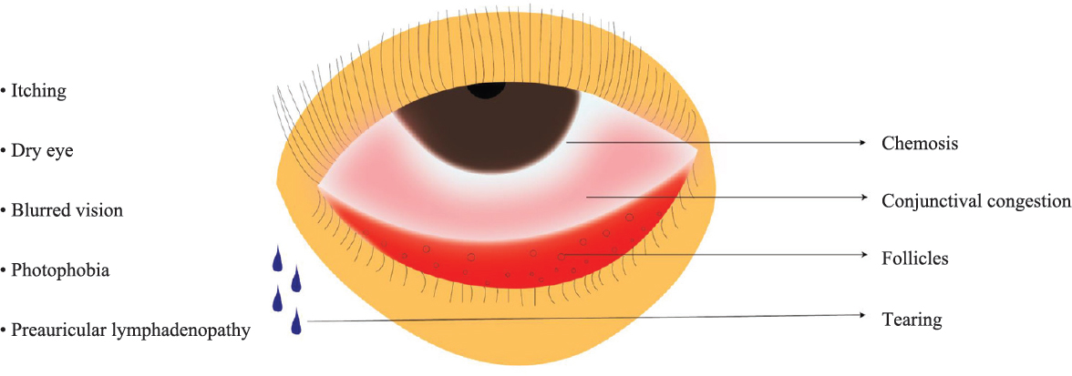 Ophthalmological signs and symptoms of coronavirus disease 2019. Chemosis, conjunctival congestion, follicles, tearing, itching, dry eye, blurred vision, photophobia and preauricular lymphadenopathy are major signs.