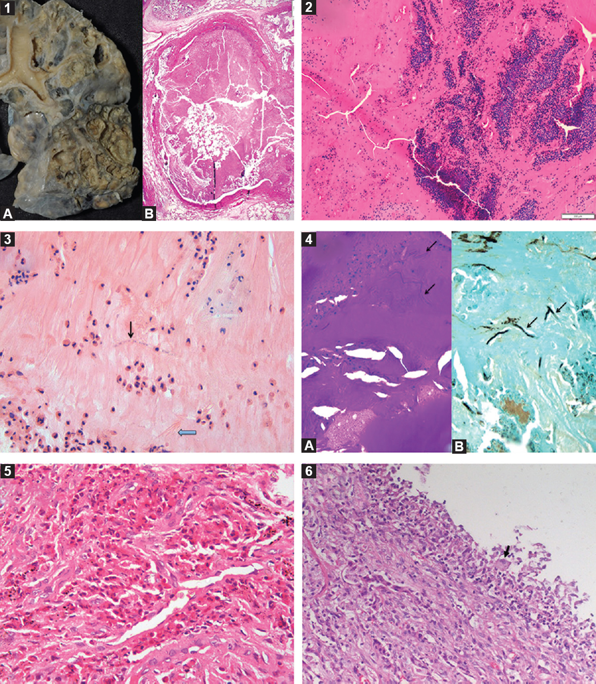 A collage of histopathological findings in allergic bronchopulmonary aspergillosis. Gross photograph showing cystically dilated bronchi and bronchioles and lumen filled with brownish mucous plugs (panel 1A). Photomicrograph showing dilated bronchial lumen filled with allergic mucin (panel 1B; H and E, ×40). Low-power photomicrograph of allergic mucin having variegated appearance, containing mucin admixed with eosinophils, eosinophilic debris and other inflammatory cells arranged in a laminar pattern (panel 2; H and E, ×100). High-power photomicrograph of allergic mucin containing mucin admixed with eosinophils, Charcot laden crystals (thick arrow) and a few septate fungal hyphae (thin arrow) (panel 3; H and E, ×400). Photomicrographs of periodic acid-Schiff stain (panel 4A, ×400) and Grocott's stain (panel 4B, ×400) highlighting scattered fungal hyphae (arrows) within allergic mucin. Photomicrograph showing alveolar spaces filled with eosinophils indicative of eosinophilic pneumonia (panel 5; H and E, ×200). Photomicrograph of bronchocentric granulomatosis (panel 6) with occasional multinucleate giant cell (black arrow).