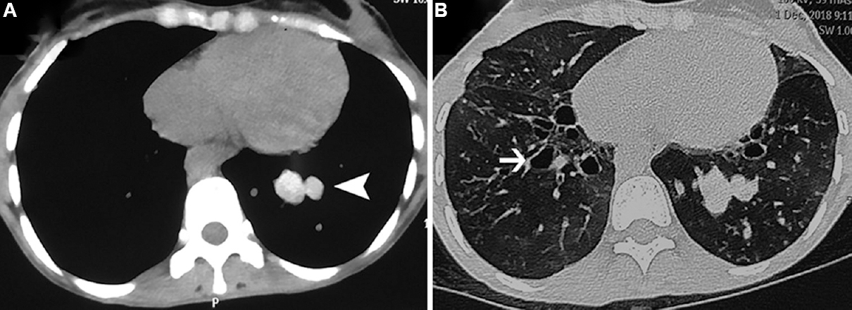 Computed tomography chest images in a patient with allergic bronchopulmonary aspergillosis. The mediastinal window (panel A) shows the presence of high-attenuation mucus (arrow head), which is visually denser than para-spinal skeletal muscle. The lung window (panel B) shows bronchiectasis (thin arrow). Other findings discernable include centrilobular nodules, tree-in-bud opacities and mosaic attenuation.