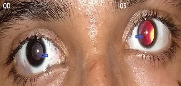 Difference in Bruckner reflex of two eyes (blue arrow). OD glow is darker while OS glow is reddish-orange.