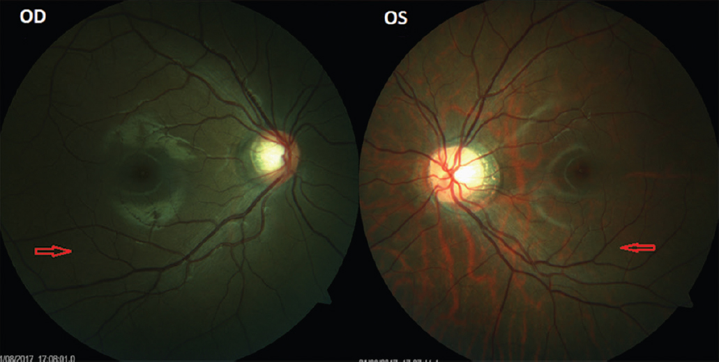 OD fundus pigmentation is darker than OS (red arrow).