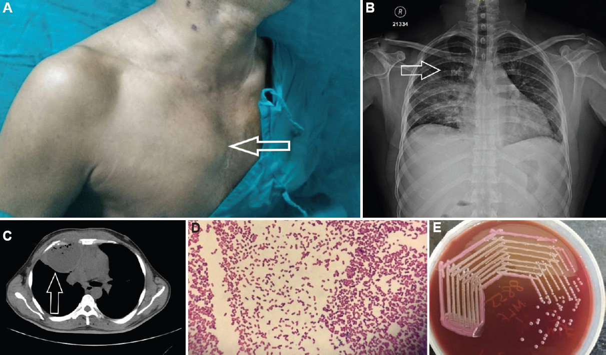 (A) Right-sided chest wall swelling (arrow). (B) Chest X-ray showing right upper lobe consolidation with cavitation (arrow). (C) Computed tomography scan thorax showing right-sided empyema with rib erosion (arrow). (D) Gram staining of sputum under ×100 magnification shows Gram-negative bacilli in chains. (E) Sputum culture done in MacConkey agar shows pink lactose fermenting colonies of Klebsiella pneumoniae.
