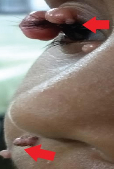 Umbilicated lesions in the right nostril, angle of mouth and ala of nose.