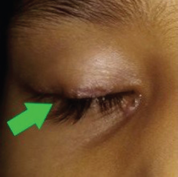 Results after extirpation of the lesions along with cauterization of the base with trichloroacetic acid.