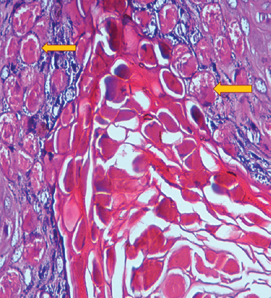 Photomicrograph of the excised lesions showing intracytoplasmic eosinophilic inclusions (yellow arrows represent Henderson-Paterson bodies) within the keratinocytes, compressing the nucleus to periphery confirming molluscum contagiosum (H and E, ×40).