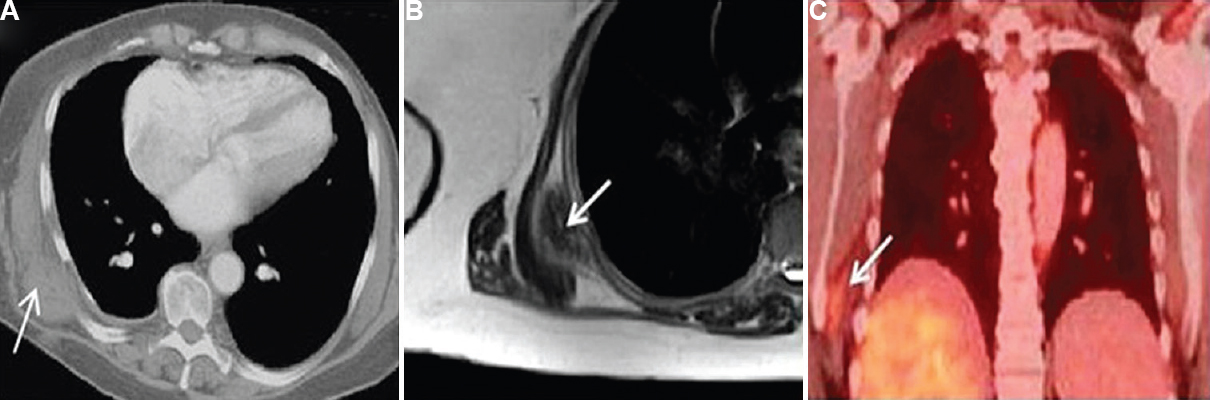 (A) Axial view chest computed tomography (CT) showing a right-sided subscapular isodense soft-tissue mass (arrow). (B) Axial view of T2-weighted magnetic resonance imaging (MRI) image showing a heterogeneous hypointense signal interlaced with strands of fat (arrow). (C) Fused positron emission tomography (PET)-CT showing low-level fluorodeoxyglucose uptake less than that of the liver (arrow).