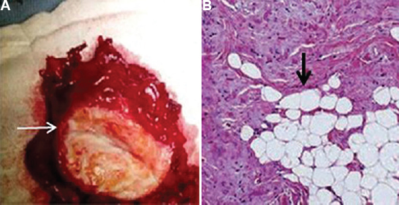 (A) Grossly, the excised elastofibroma dorsi was irregular rubbery (white arrow), and non-capsulated. (B) Microscopically (H and E, ×100), elastin fibres admixed with fibrous tissue and mature fatty cells (black arrow).