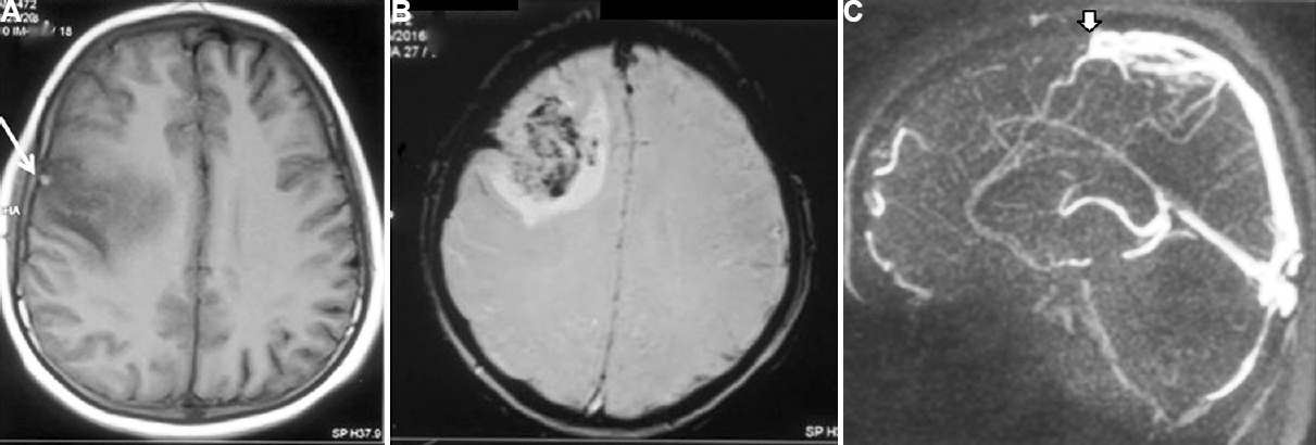 Magnetic resonance imaging (MRI) and magnetic resonance venography (MRV) of a 21 years old male patient with cerebral venous sinus thrombosis who presented with headache, status epilepticus and altered sensorium for 10 days. (A) Haemorrhagic infarctions involving parietal areas (white arrow). (B) Gradient echo image showing blooming in the same area. (C) MRV shows thrombosis of superior sagittal sinus (white arrow). His serum vitamin B12 level was 83 pg/ml and homocysteine 50 μmol/l. He was treated with vitamin B12 (1000 μg) intramuscular injection, daily for 10 days followed by weekly for one month and then monthly thereafter. He improved completely at three months and his homocysteine level was normal (7.47 μg/ml).