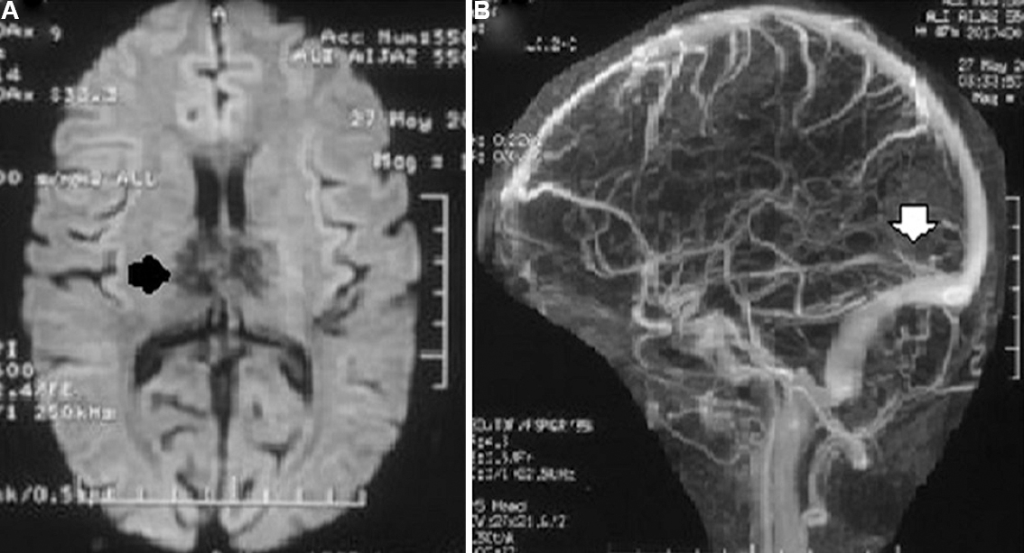 Magnetic resonance imaging (MRI) and magnetic resonance venography (MRV) of a patient with cerebral venous sins thrombosis who presented with headache, forgetfulness, behavioural abnormality and parkinsonian features. (A) Diffusion MRI reveals haemorrhagic infarction of anterior thalamus (black arrow). (B) MRV reveals deep cerebral vein thrombosis (white arrow). He had low serum folate (2 ng/ml) and high homocysteine (30 μg/ml). He was treated with anticoagulant and folic acid (5 mg daily, per oral), and improved completely at three months. His repeat serum folate (15 ng/ml) and homocysteine (9.3 μg/ml) at three months were normal.