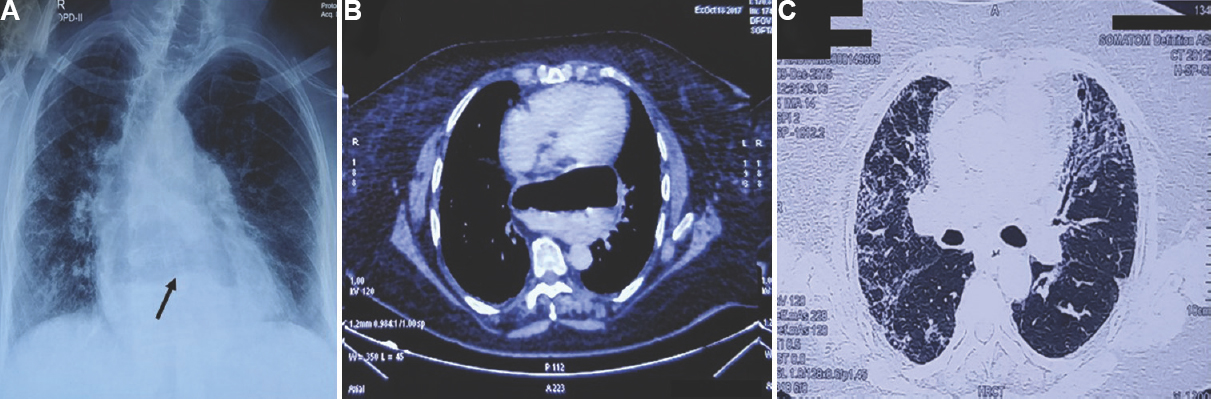 (A) Chest radiograph (postero-anterior view) showing scoliosis and hiatus hernia. Arrows point to the air–fluid level in the stomach on the chest (A) X-ray and (B) computed tomography (CT) chest and changes of bilateral lung fibrosis (A and C). (C) CT chest (pulmonary window) showing changes of interstitial lung fibrosis (lingula on the left side, middle and lower lobes on the right side).