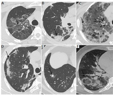 Common computed tomography (CT) manifestations (indicated by arrows) of COVID-19 pneumonia in different patients: (A) ground-glass opacities, (B) consolidation, (C) crazy-paving, (D) sub-pleural linear opacities and parenchymal bands, (E) halo sign, (F) reverse halo sign.