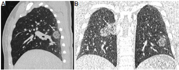 CT chest of a 45 yr old female who presented with fever and moderate dyspnoea and history of contact with COVID-19 pneumonia patient. Two RT-PCR tests for COVID-19 virus done from oropharyngeal swab samples days on 5 and 7 of symptoms were negative. CT chest was done on the eighth day. (A and B) Sagittal and coronal CT sections in the lung window showed areas of ground-glass opacities (arrow) in the right upper and middle lobes and left lower lobe. Computed tomography was reported COVID-19 Reporting and Data System Category 5 (CO-RADS 5); the patient was isolated and managed as COVID-19 pneumonia. Repeat RT-PCR test was positive for COVID-19 on the ninth day.