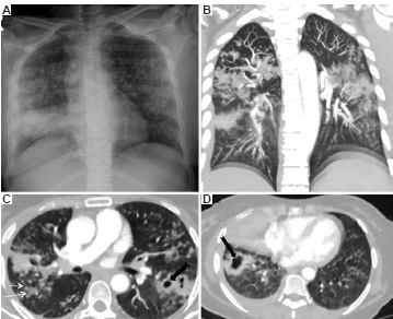 A 60 yr old female, COVID-19 RT-PCR positive, was planned to start on tocilizumab in view of her rising inflammatory markers and worsening hypoxia. (A) Chest X-ray revealed nodular opacities in both upper and mid zones with dense consolidation in the right lower zone; findings were indeterminate for coronavirus disease pneumonia. (B-D) CT chest showed multiple random and centrilobular nodules (white arrows) and cavitating lesions (black arrows). These features were consistent with pulmonary tuberculosis (confirmed with sputum GeneXpert), so tocilizumab was withheld.